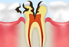C3：後期のむし歯神経にまで達したむし歯