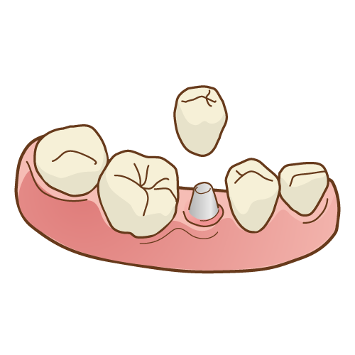 歯が無くなったらどうする？