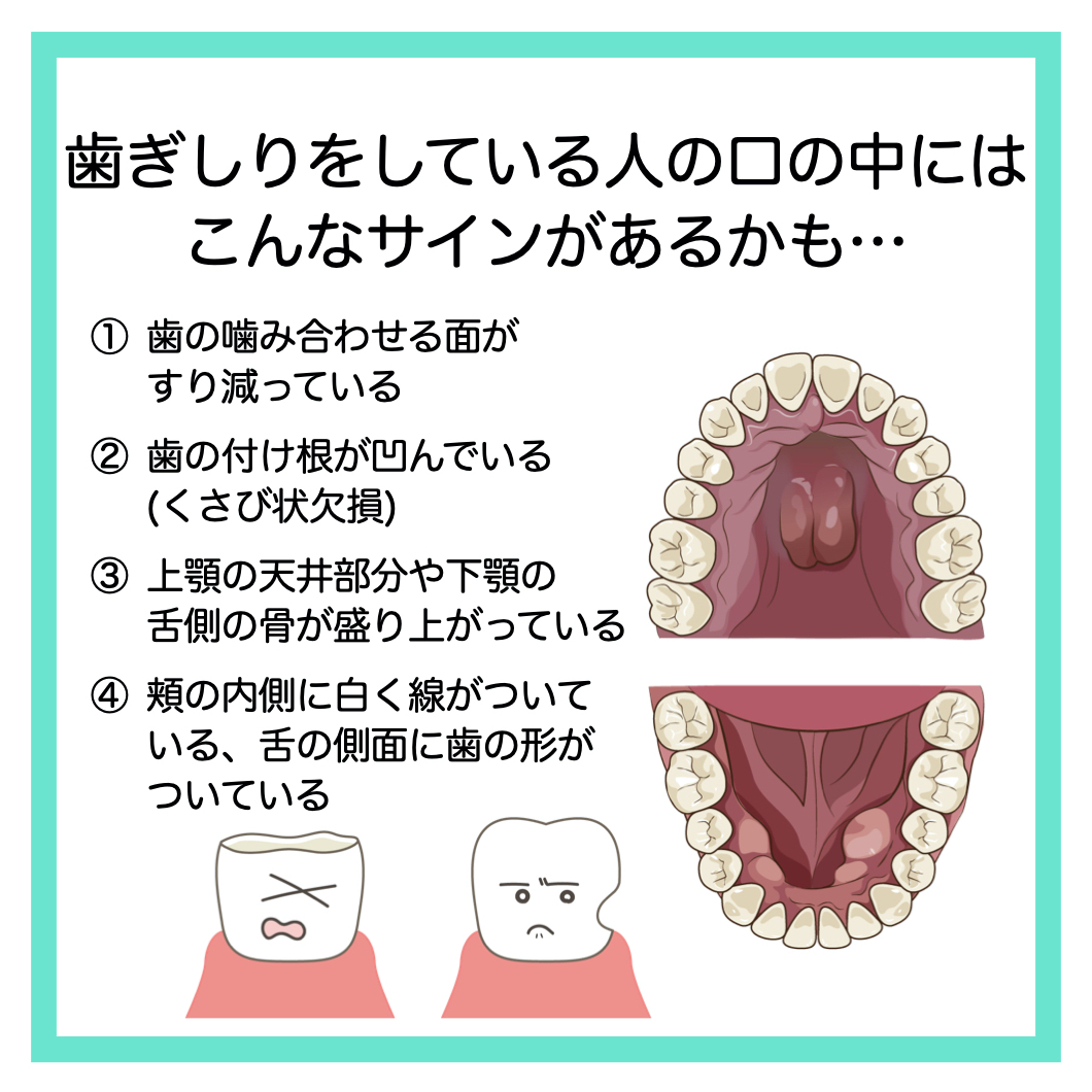 歯を守るマウスピース