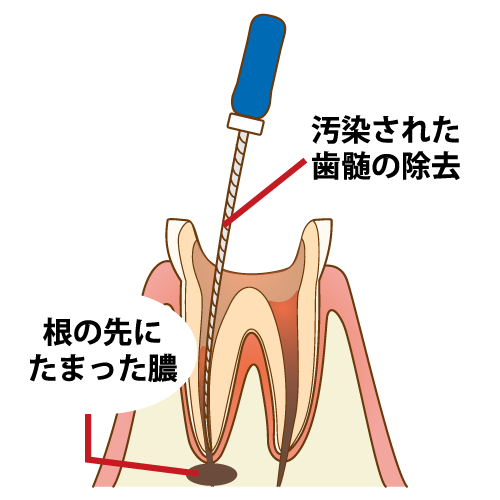 「根管治療」について