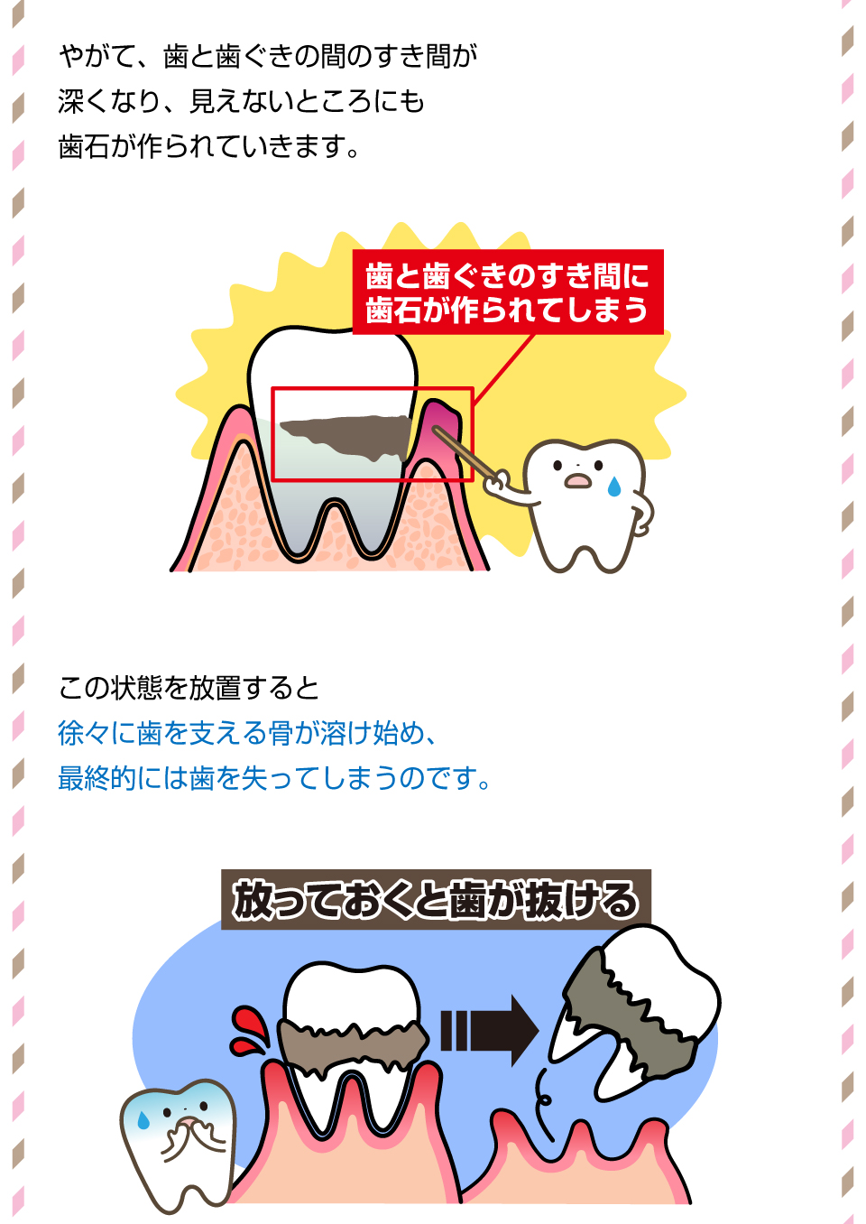 放置すると歯が抜ける！？「歯石」のリスクとは？