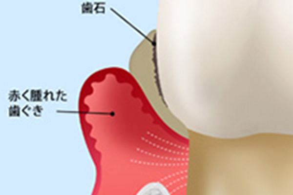 歯周病とは？