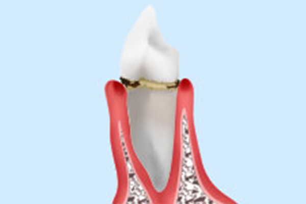 中等度歯周炎
