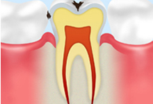 C1：初期の歯エナメル質のむし歯