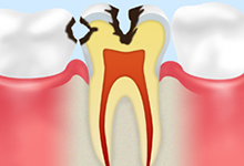 C2：中期のむし歯象牙質のむし歯