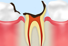 C4：重度のむし歯歯冠（歯の上の部分）がほとんど溶かされたむし歯